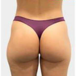 Gluteo1.jpg