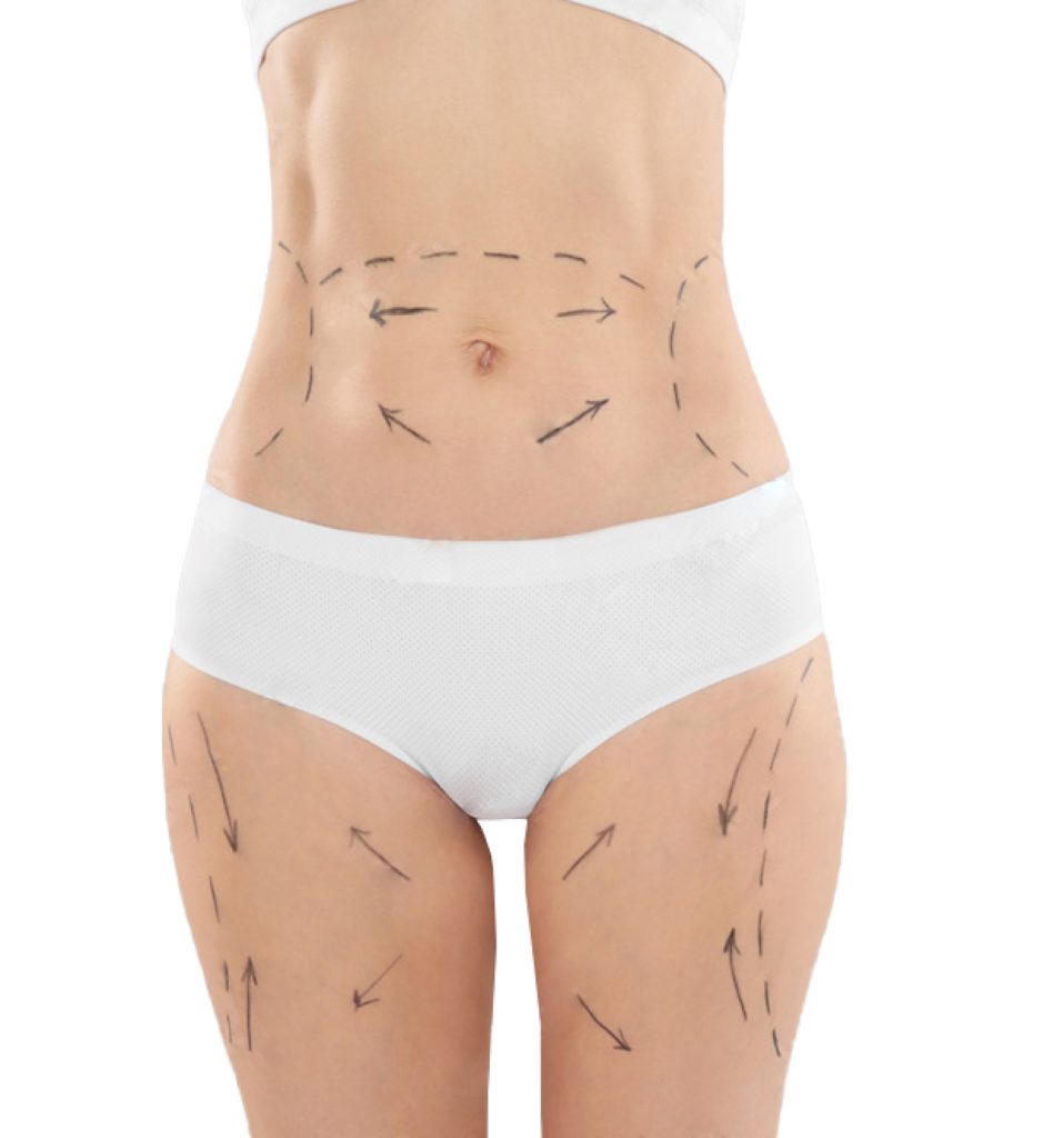 lipotransferencia de grasa