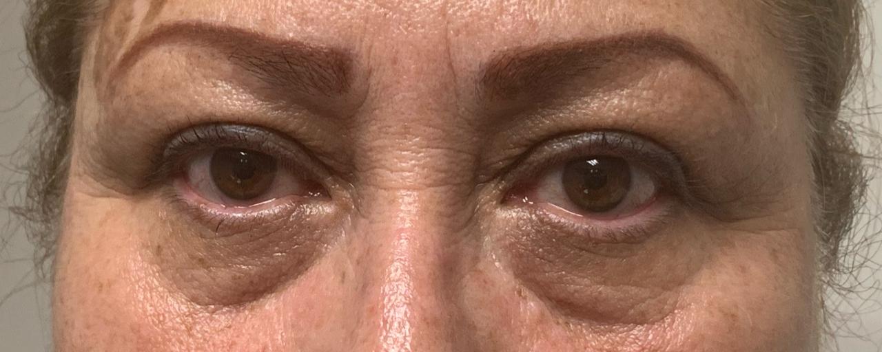Ojeras-antes.jpg