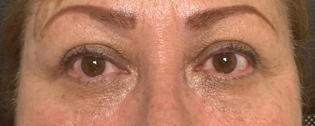 Ojeras-despues.jpg