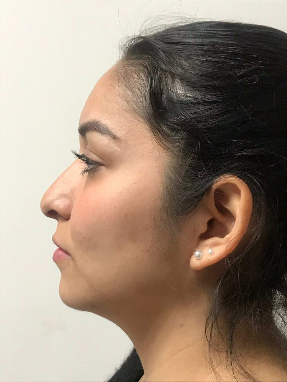 Rinoplastia-antes1.jpg